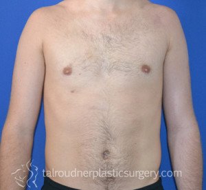 Male Breast Reduction (Gynecomastia)