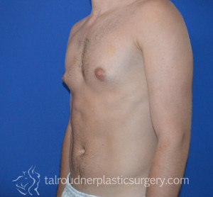 Male Breast Reduction (Gynecomastia)