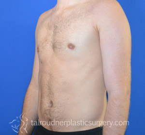Male Breast Reduction (Gynecomastia)