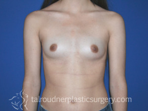Breast Augmentation