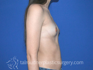 Breast Augmentation
