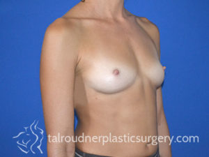 Breast Plastic Surgery