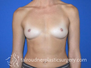 Breast Plastic Surgery