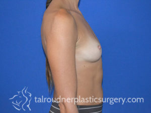 Breast Plastic Surgery