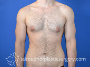 Male Plastic Surgery