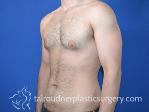 Male Plastic Surgery