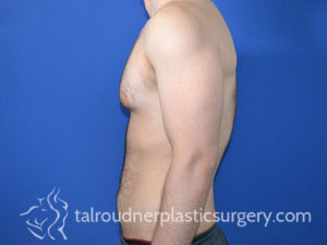 Male Plastic Surgery