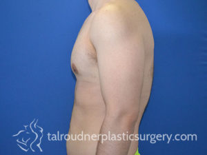 Male Plastic Surgery