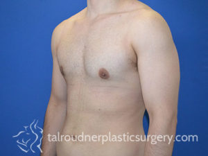 Male Plastic Surgery