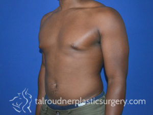 Male Plastic Surgery