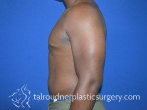 Male Plastic Surgery