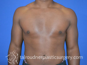 Male Plastic Surgery