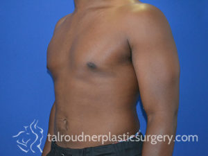 Male Plastic Surgery