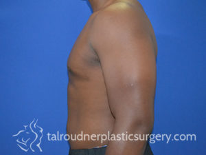 Male Plastic Surgery