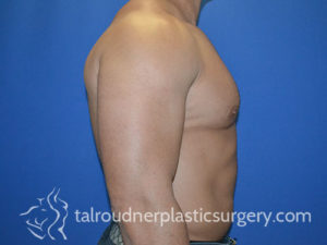 Male Plastic Surgery