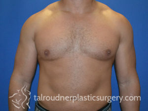 Male Plastic Surgery