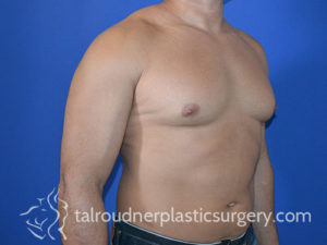 Male Plastic Surgery