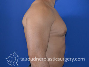 Male Plastic Surgery
