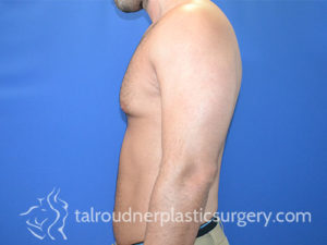 Male Plastic Surgery