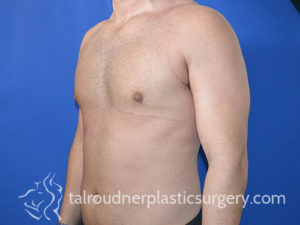 Male Plastic Surgery