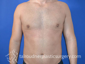 Male Plastic Surgery