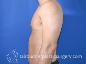 Male Plastic Surgery