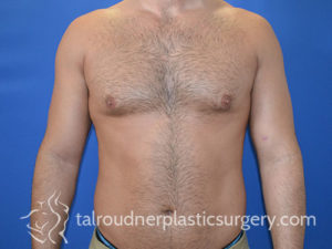 Male Plastic Surgery