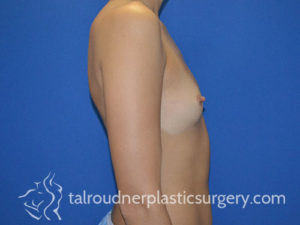 Breast Plastic Surgery