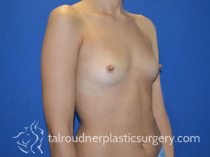 Breast Plastic Surgery