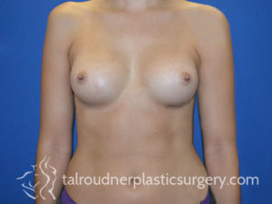 Breast Plastic Surgery