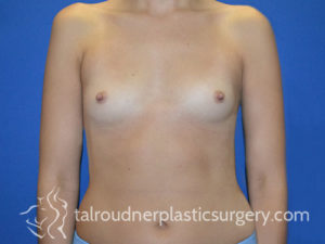 Breast Plastic Surgery