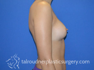 Breast Plastic Surgery