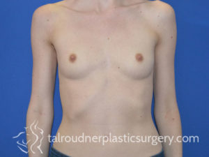 Breast Plastic Surgery
