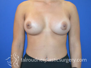 Breast Plastic Surgery