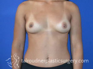 Breast Plastic Surgery