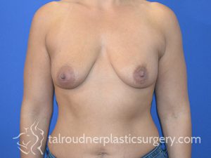 Breast Lift
