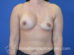 Breast Revision