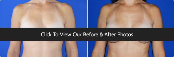 Breast Implants Miami - Silicone and Saline